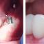 Имплантация зубов All-on-6 (Всё на шести)